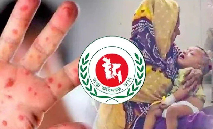 হাম ও উপসর্গে মৃত্যু আরও ১০ শিশুর